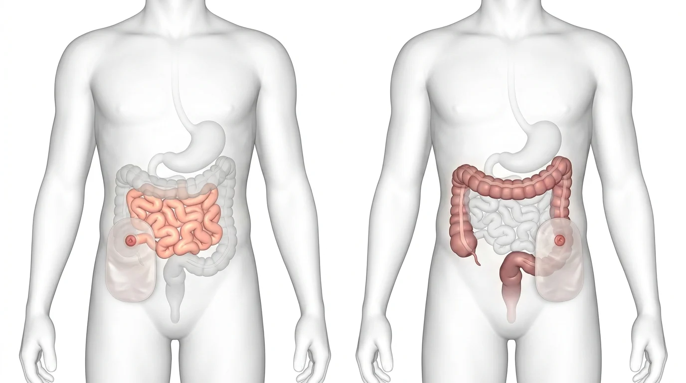ileostomy vs colostomy